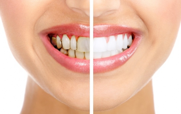 Alanya'da diş sağlığını nasıl koruyabilirim? OD Clinic sizler için yazdı